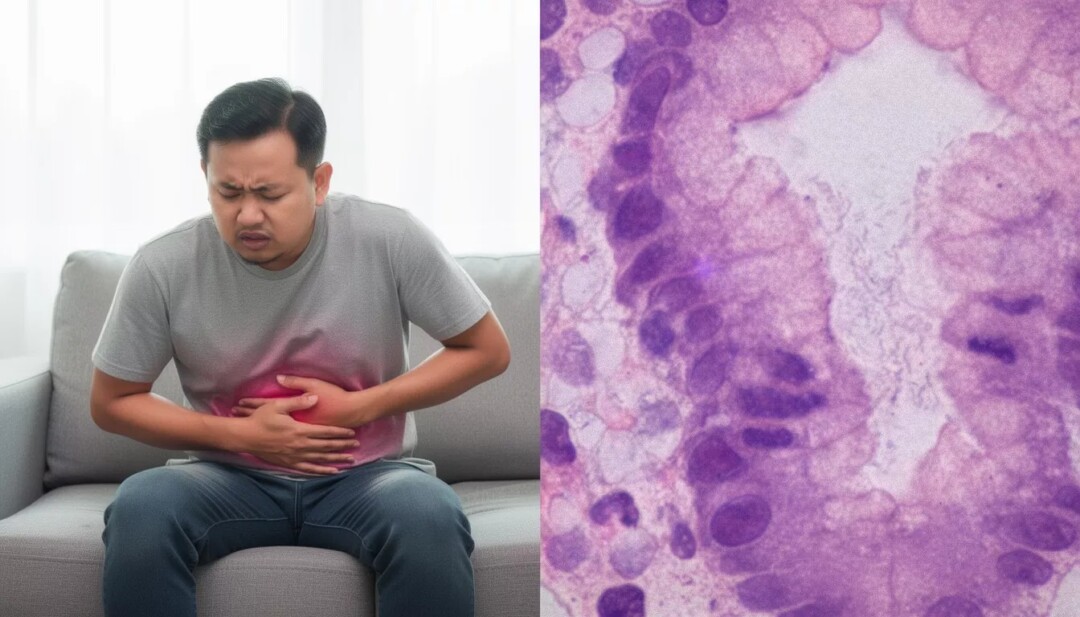 Helicobacter pylori: Hidden Germ Behind Many Stomach Problems